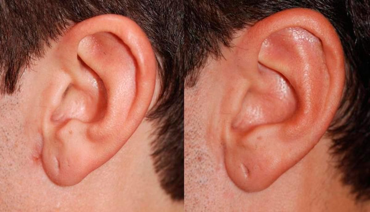 Otoplasty Before & After Gallery - Patient 203948 - Image 3