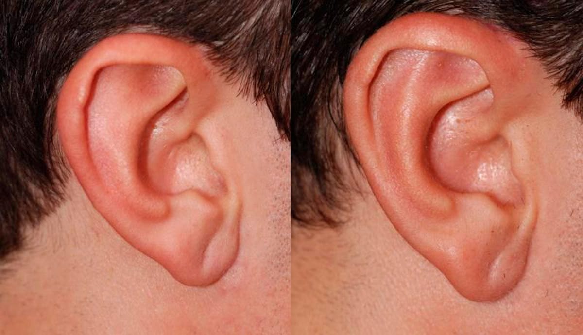 Otoplasty Before & After Gallery - Patient 203948 - Image 4