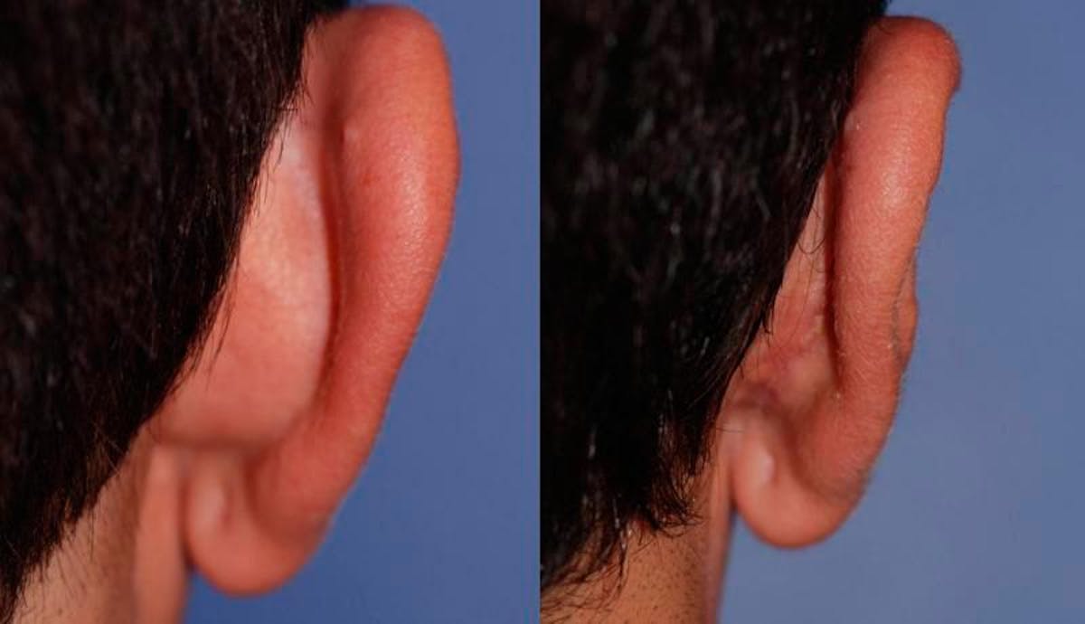 Otoplasty Before & After Gallery - Patient 203948 - Image 5