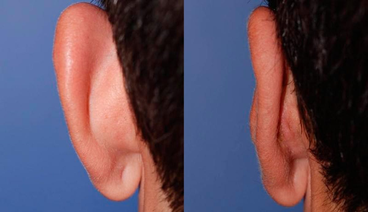Otoplasty Before & After Gallery - Patient 203948 - Image 6