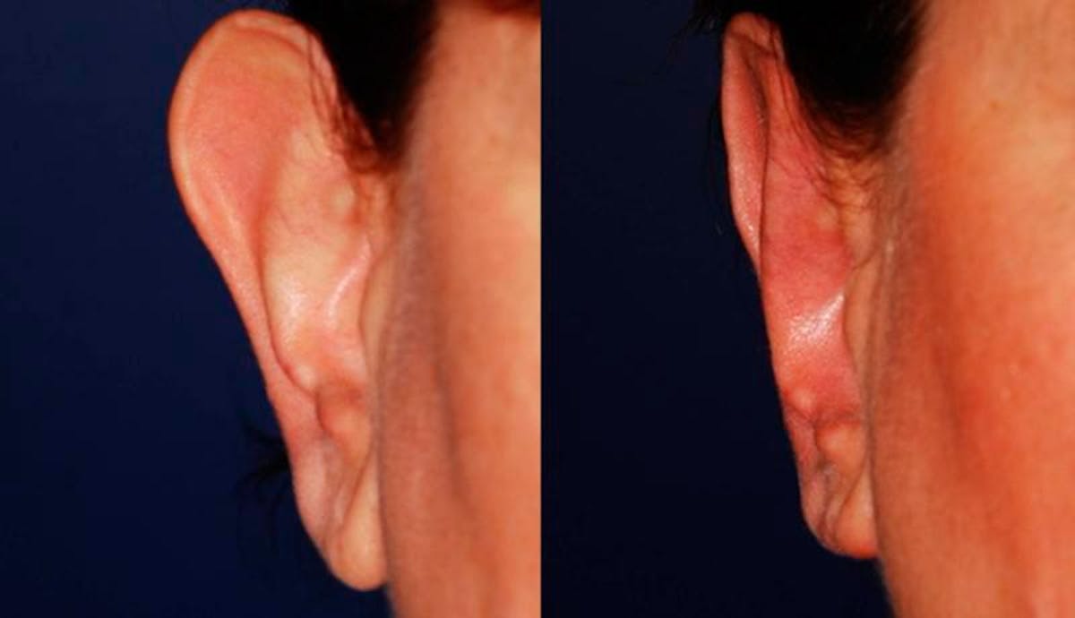 Otoplasty Before & After Gallery - Patient 136138 - Image 1