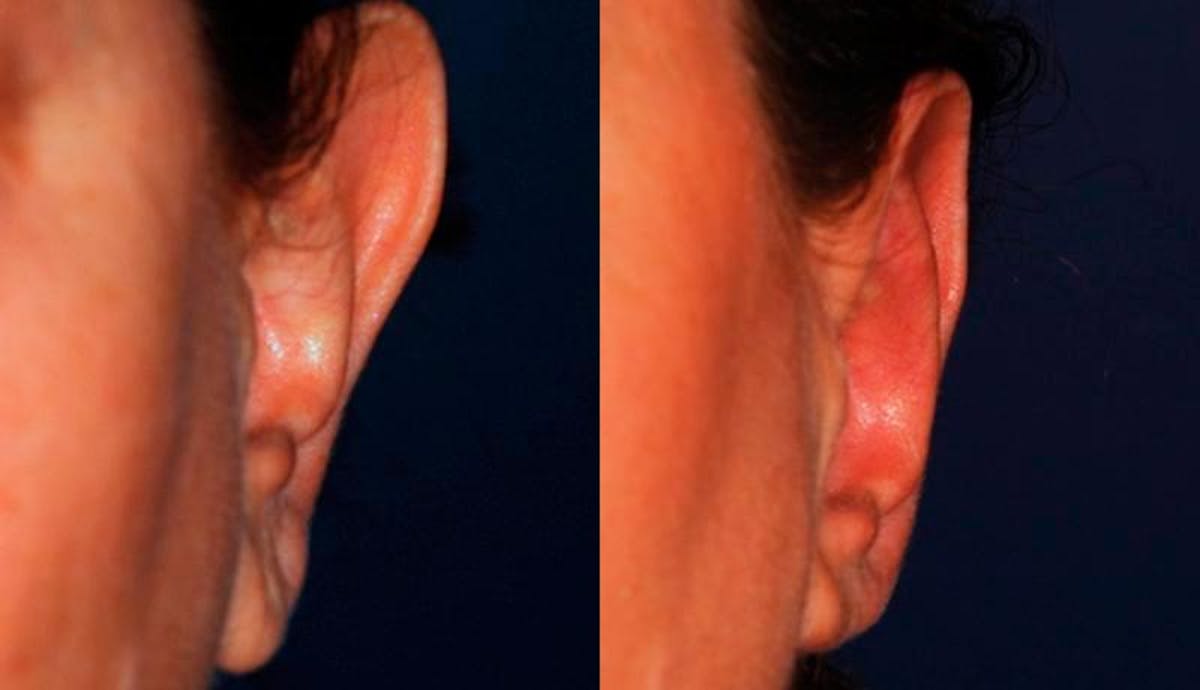 Otoplasty Before & After Gallery - Patient 136138 - Image 2