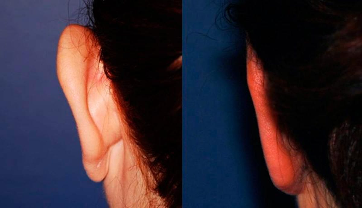 Otoplasty Before & After Gallery - Patient 136138 - Image 3