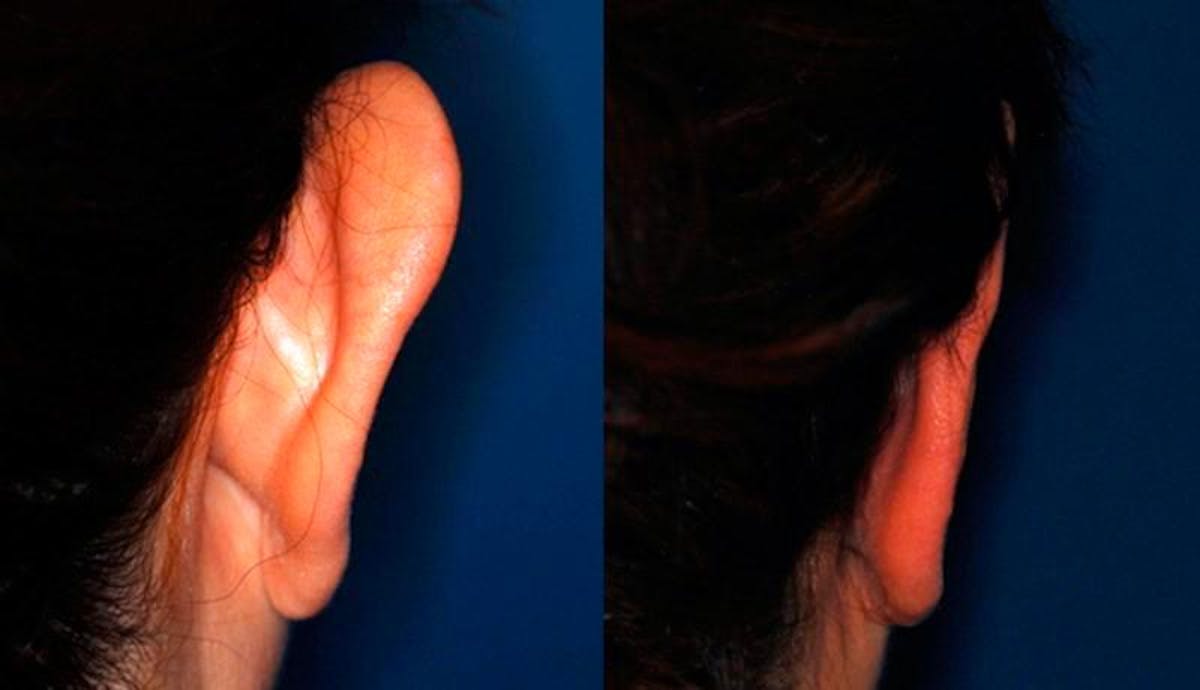 Otoplasty Before & After Gallery - Patient 136138 - Image 4