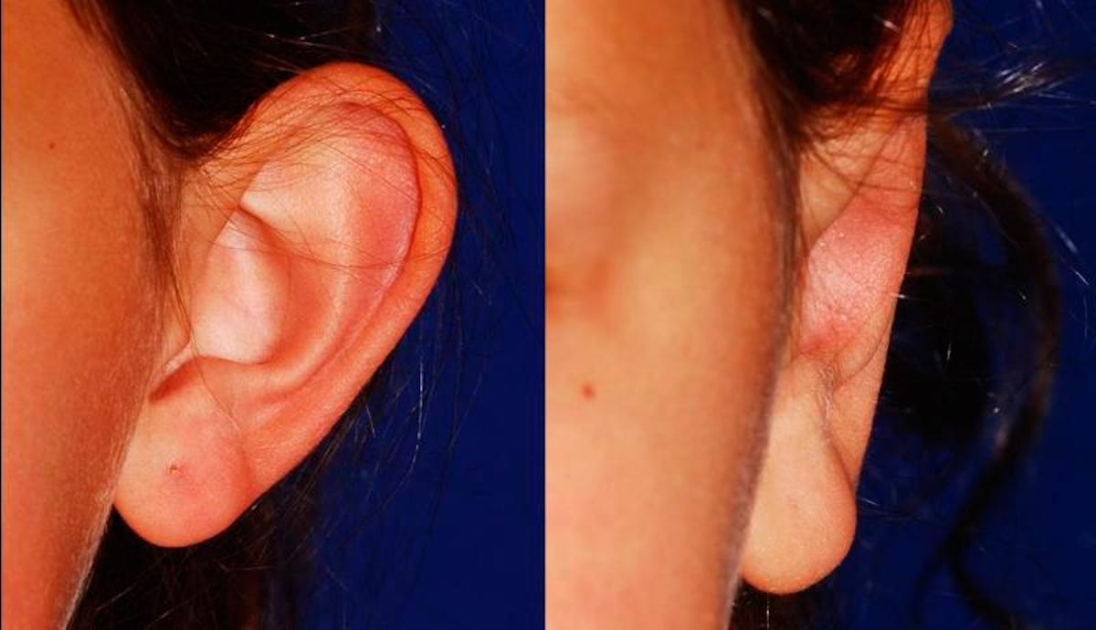 Otoplasty Before & After Gallery - Patient 116571 - Image 1