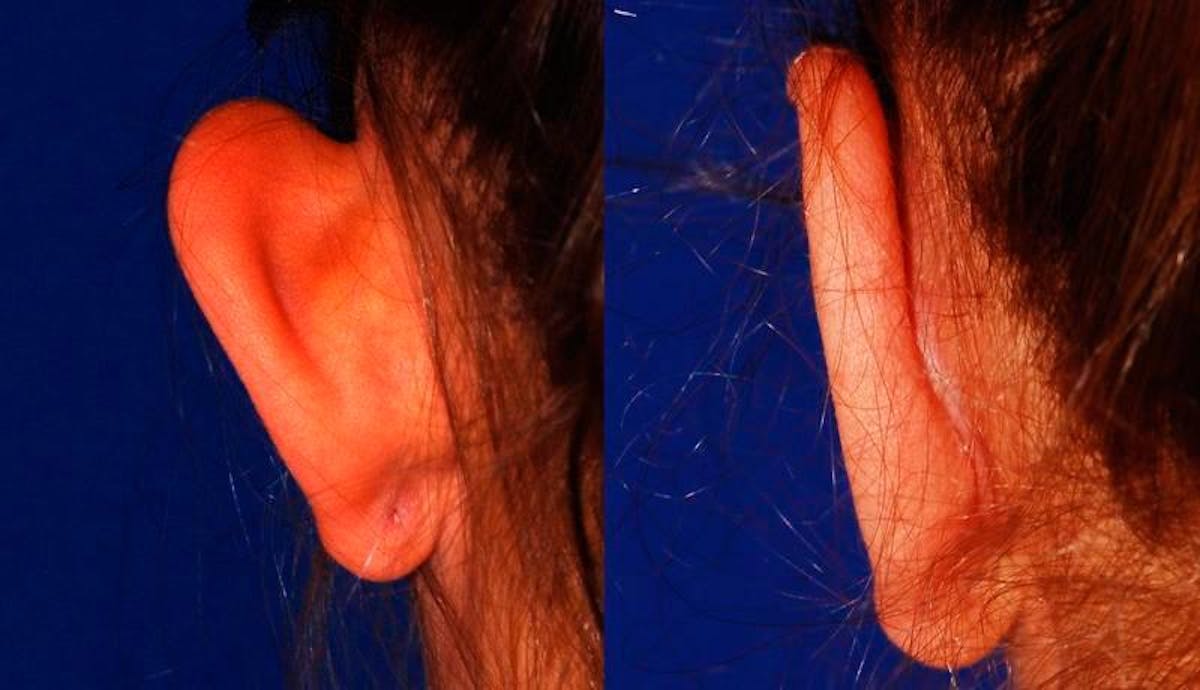 Otoplasty Before & After Gallery - Patient 116571 - Image 2