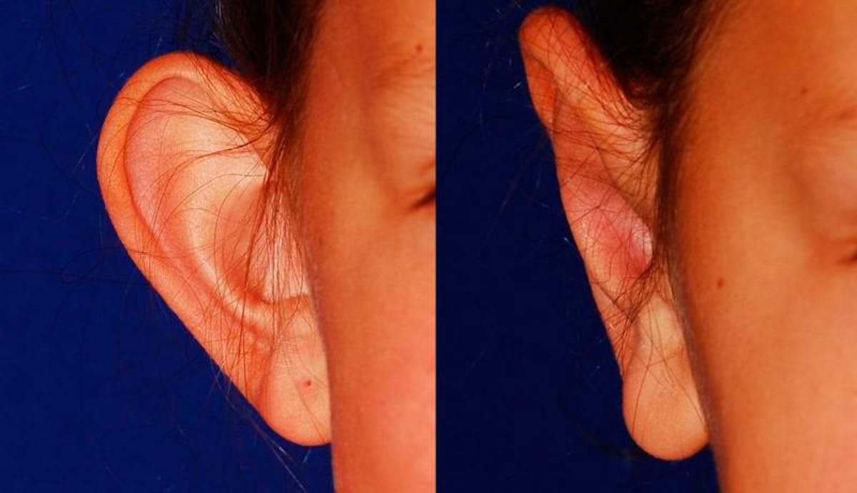 Otoplasty Before & After Gallery - Patient 116571 - Image 3