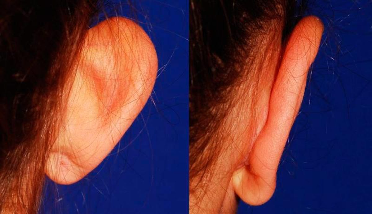 Otoplasty Before & After Gallery - Patient 116571 - Image 4