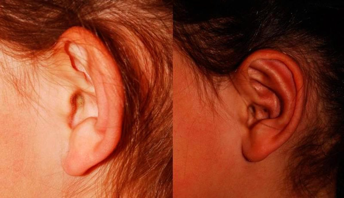 Otoplasty Before & After Gallery - Patient 116571 - Image 5