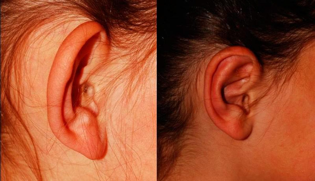 Otoplasty Before & After Gallery - Patient 116571 - Image 6