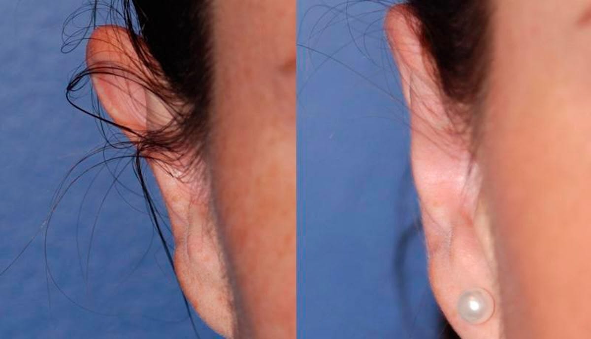 Otoplasty Before & After Gallery - Patient 376772 - Image 1