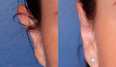 Otoplasty Before & After Gallery - Patient 376772 - Image 1