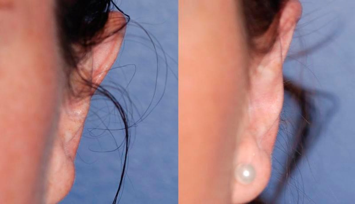 Otoplasty Before & After Gallery - Patient 376772 - Image 2