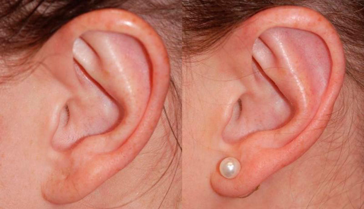 Otoplasty Before & After Gallery - Patient 376772 - Image 3