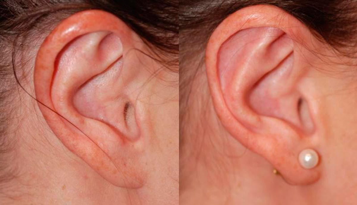 Otoplasty Before & After Gallery - Patient 376772 - Image 4