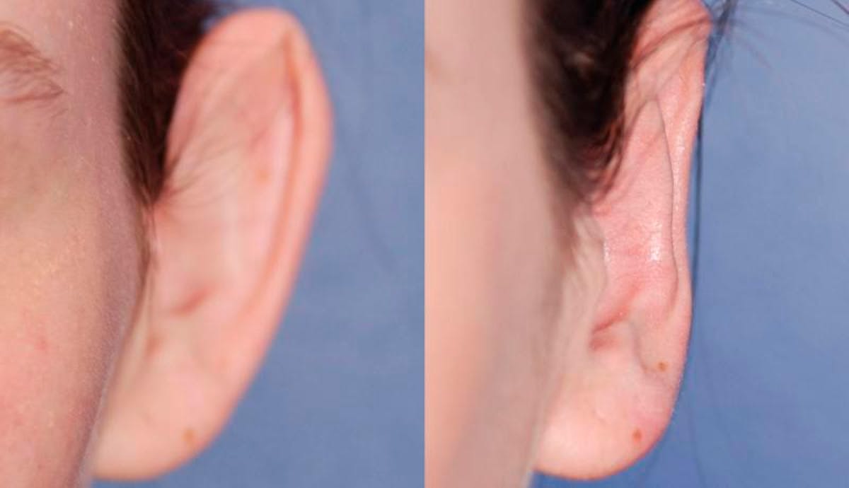 Otoplasty Before & After Gallery - Patient 229530 - Image 1