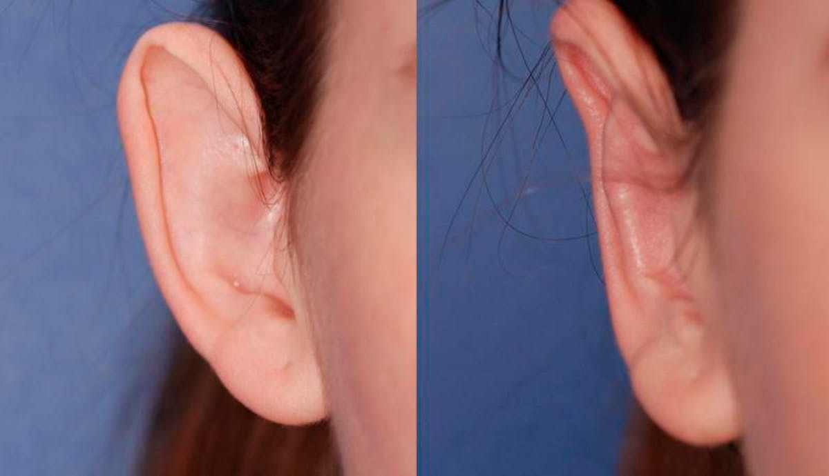 Otoplasty Before & After Gallery - Patient 229530 - Image 2
