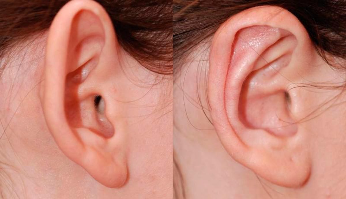 Otoplasty Before & After Gallery - Patient 229530 - Image 3