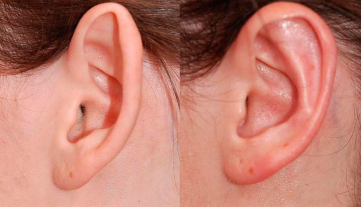 Otoplasty Before & After Gallery - Patient 229530 - Image 4