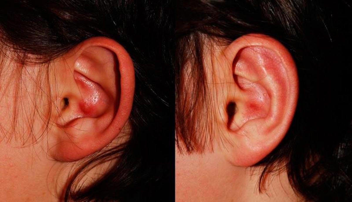 Otoplasty Before & After Gallery - Patient 400509 - Image 1