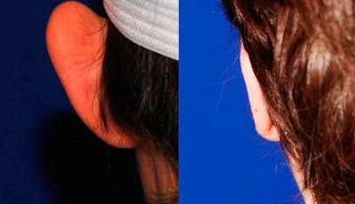 Otoplasty Before & After Gallery - Patient 334155 - Image 1