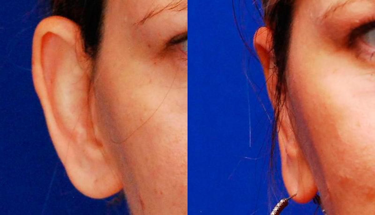 Otoplasty Before & After Gallery - Patient 245941 - Image 1