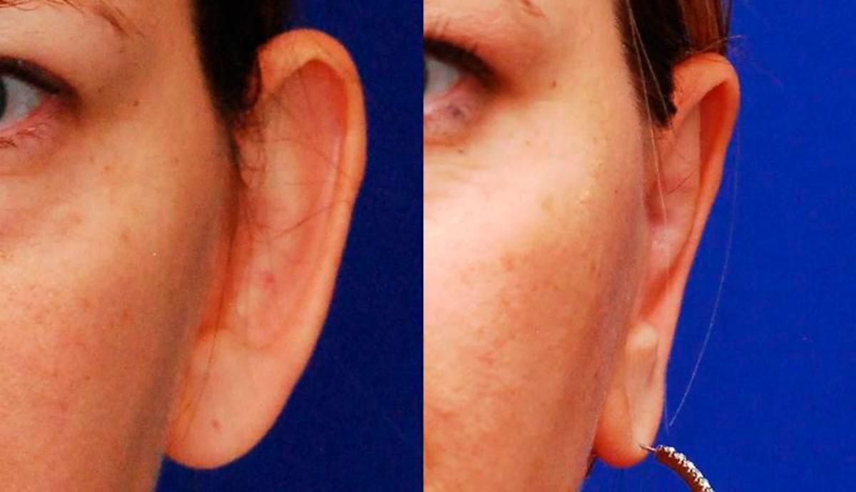 Otoplasty Before & After Gallery - Patient 245941 - Image 2