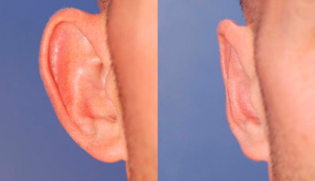 Otoplasty Before & After Gallery - Patient 262735 - Image 1