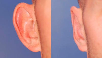 Otoplasty Before & After Gallery - Patient 262735 - Image 1