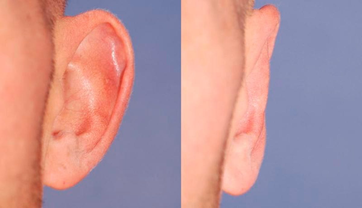 Otoplasty Before & After Gallery - Patient 262735 - Image 2