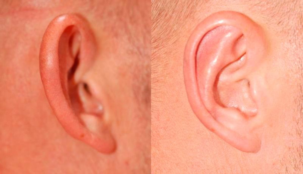 Otoplasty Before & After Gallery - Patient 262735 - Image 3