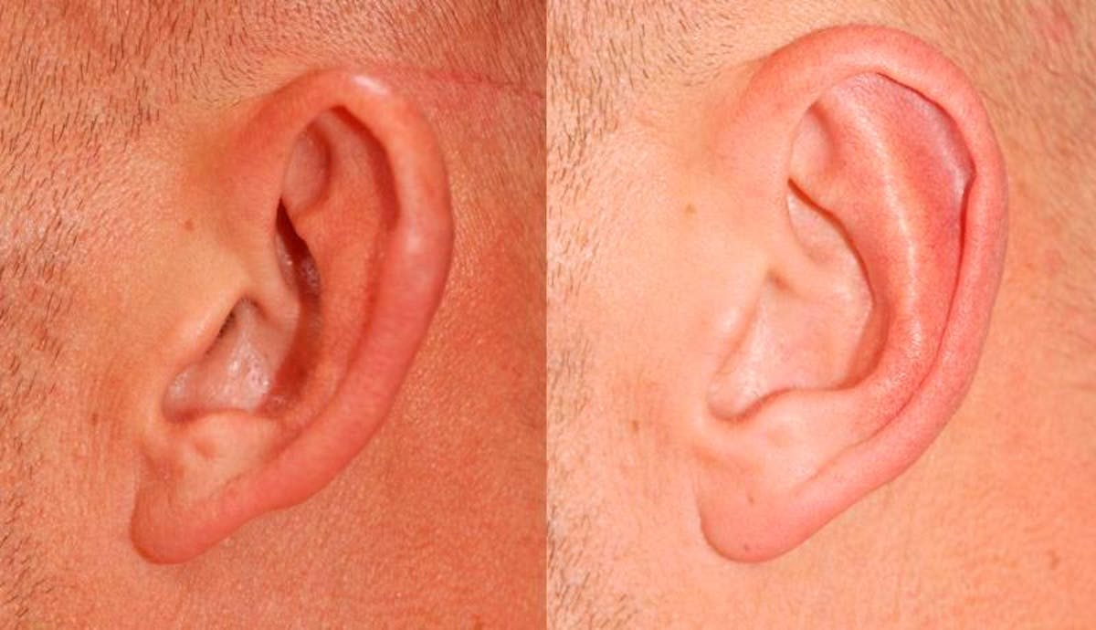 Otoplasty Before & After Gallery - Patient 262735 - Image 4