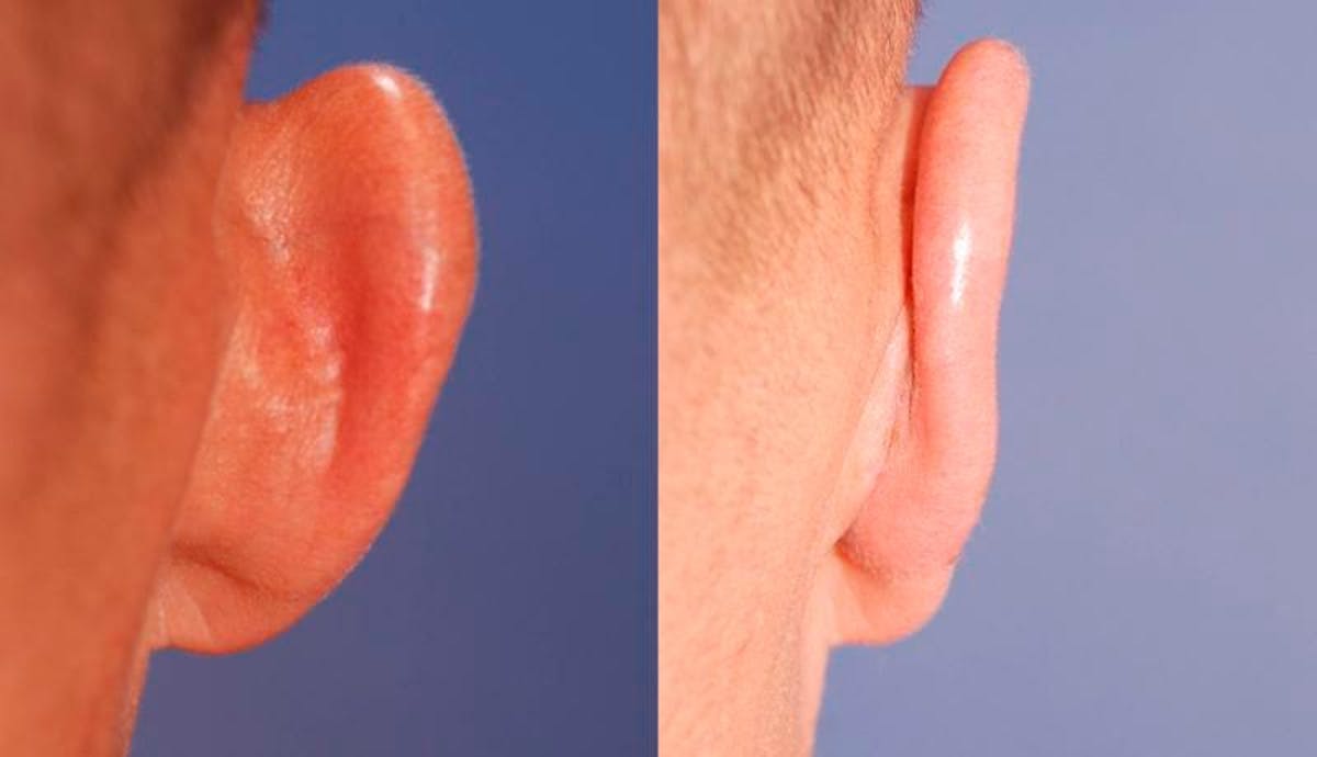 Otoplasty Before & After Gallery - Patient 262735 - Image 5