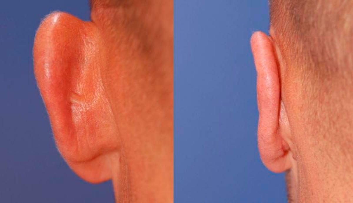 Otoplasty Before & After Gallery - Patient 262735 - Image 6