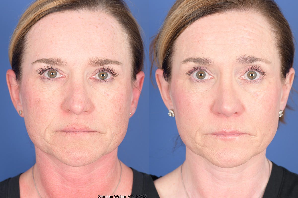 Revision Rhinoplasty Before & After Gallery - Patient 187098 - Image 1