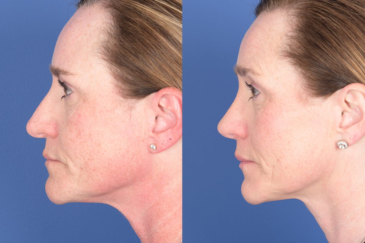 Revision Rhinoplasty Before & After Gallery - Patient 187098 - Image 2