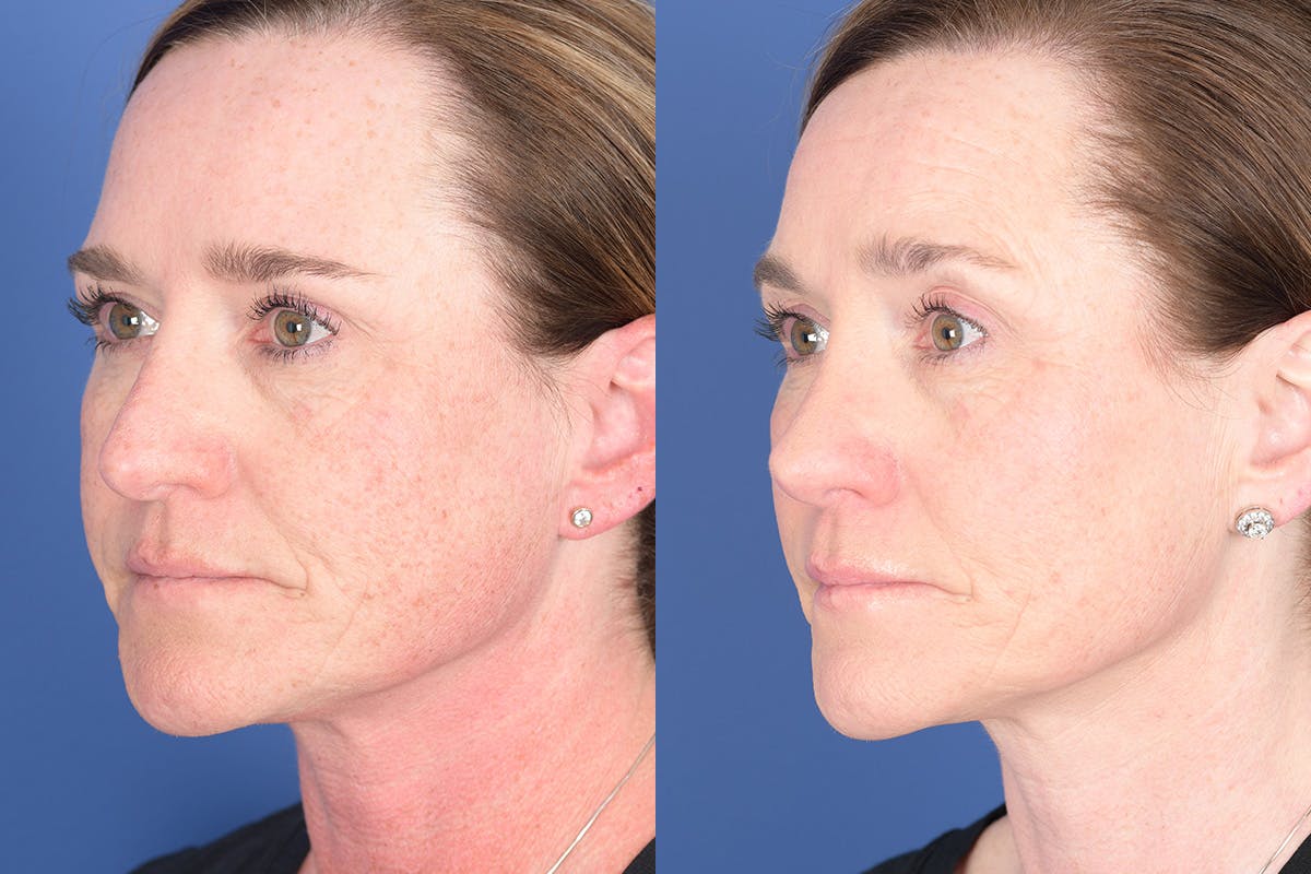 Revision Rhinoplasty Before & After Gallery - Patient 187098 - Image 3