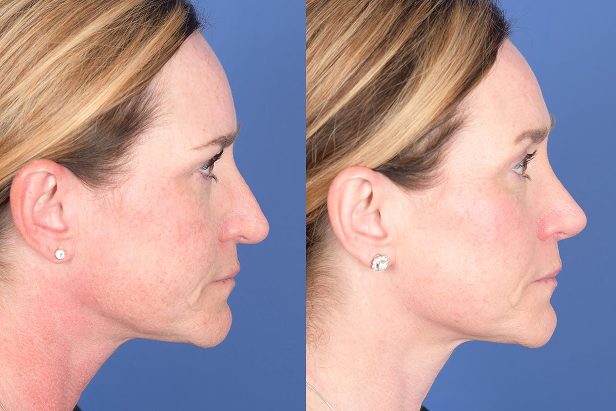 Revision Rhinoplasty Before & After Gallery - Patient 187098 - Image 4