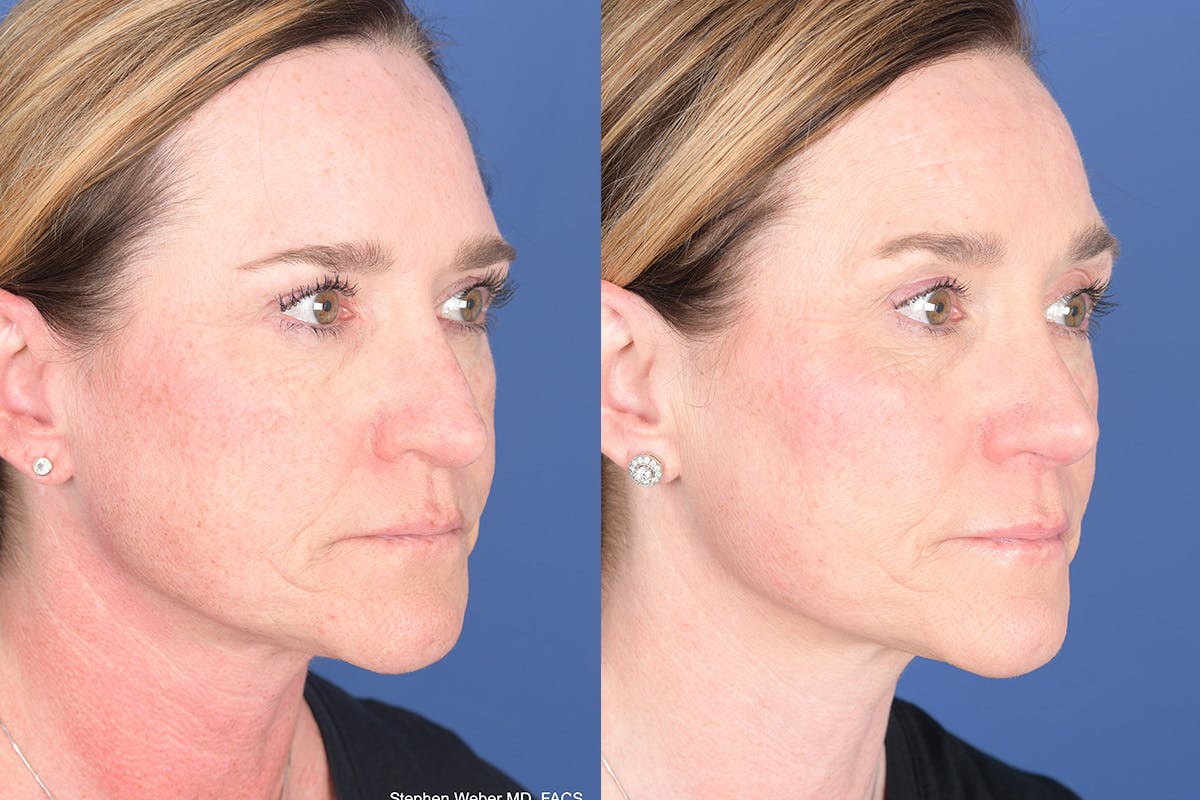 Revision Rhinoplasty Before & After Gallery - Patient 187098 - Image 5