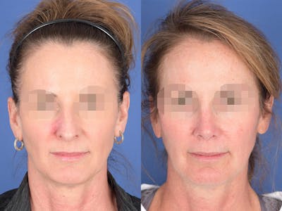 Revision Rhinoplasty Before & After Gallery - Patient 725104 - Image 1