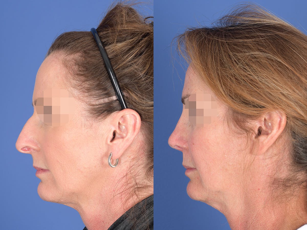 Revision Rhinoplasty Before & After Gallery - Patient 725104 - Image 2