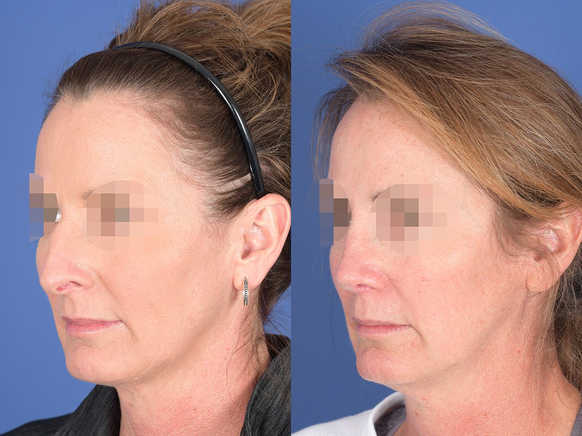 Revision Rhinoplasty Before & After Gallery - Patient 725104 - Image 3