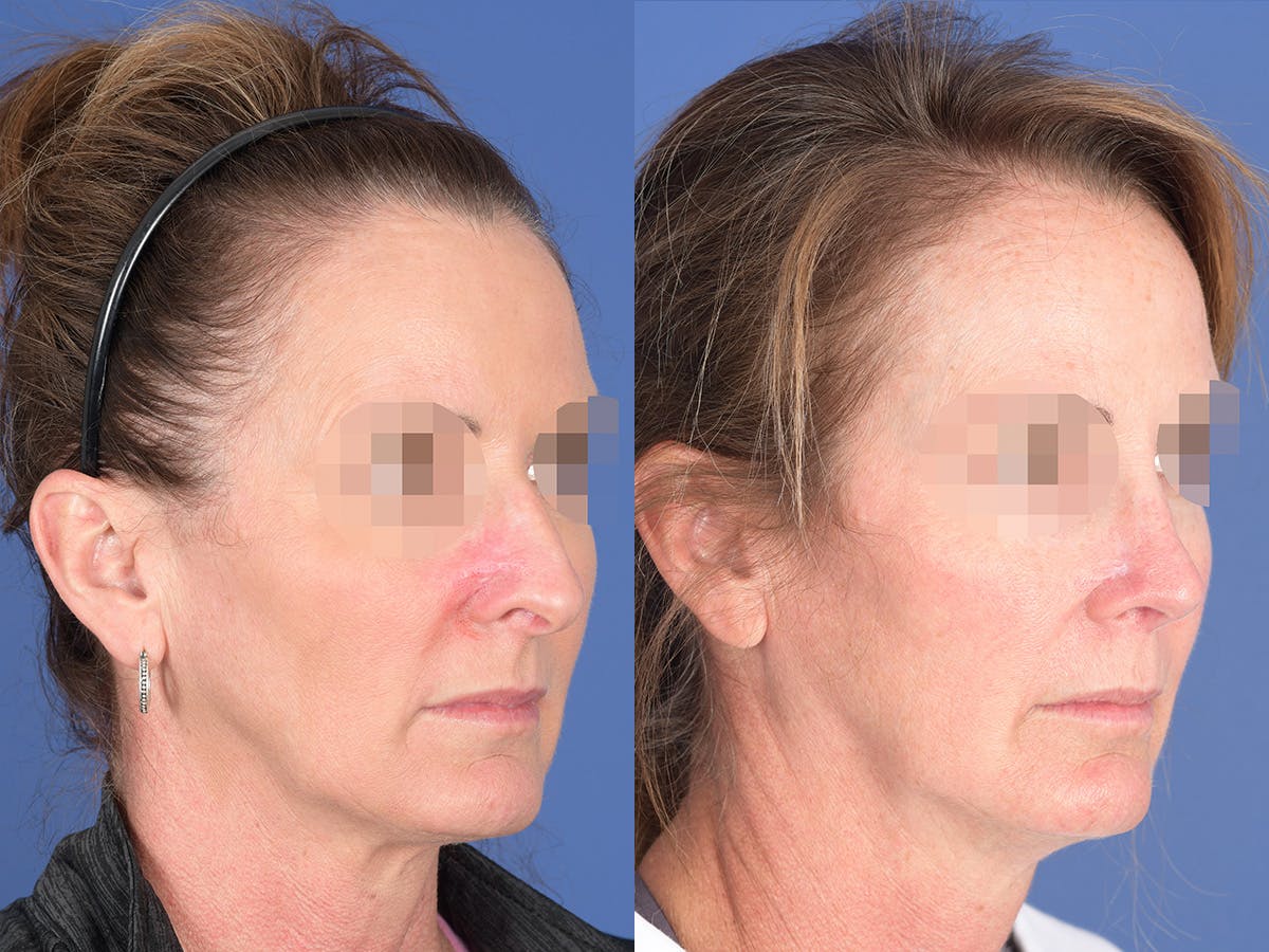 Revision Rhinoplasty Before & After Gallery - Patient 725104 - Image 4