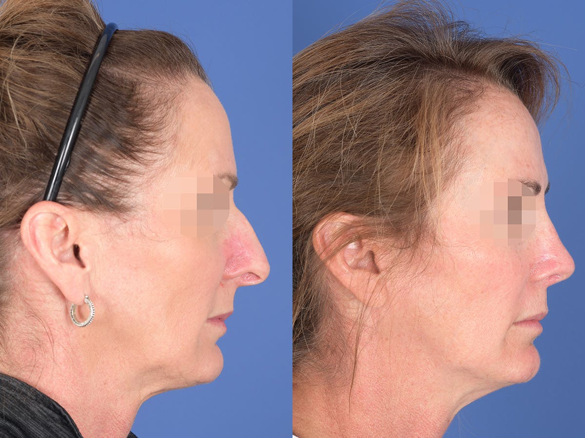 Revision Rhinoplasty Before & After Gallery - Patient 725104 - Image 5