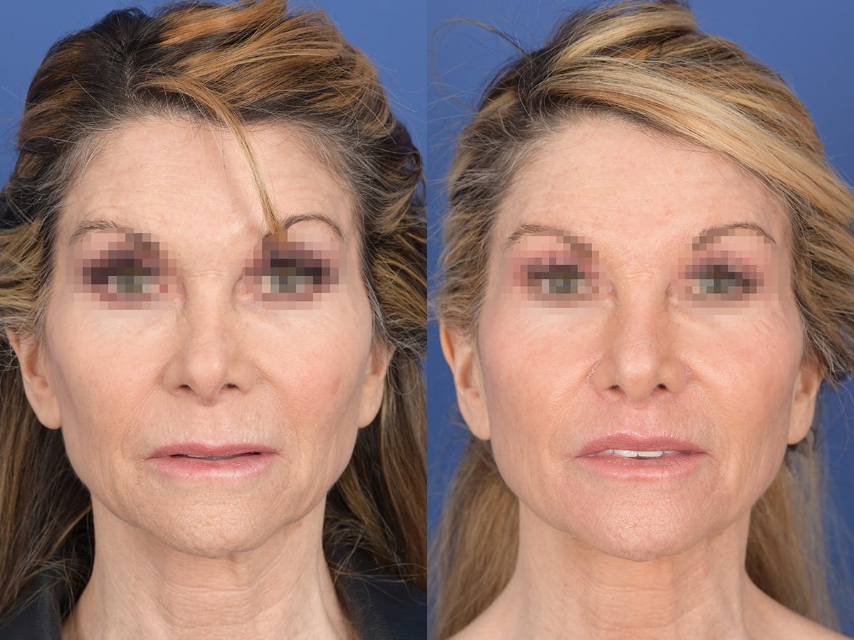 Revision Rhinoplasty Before & After Gallery - Patient 145048 - Image 1