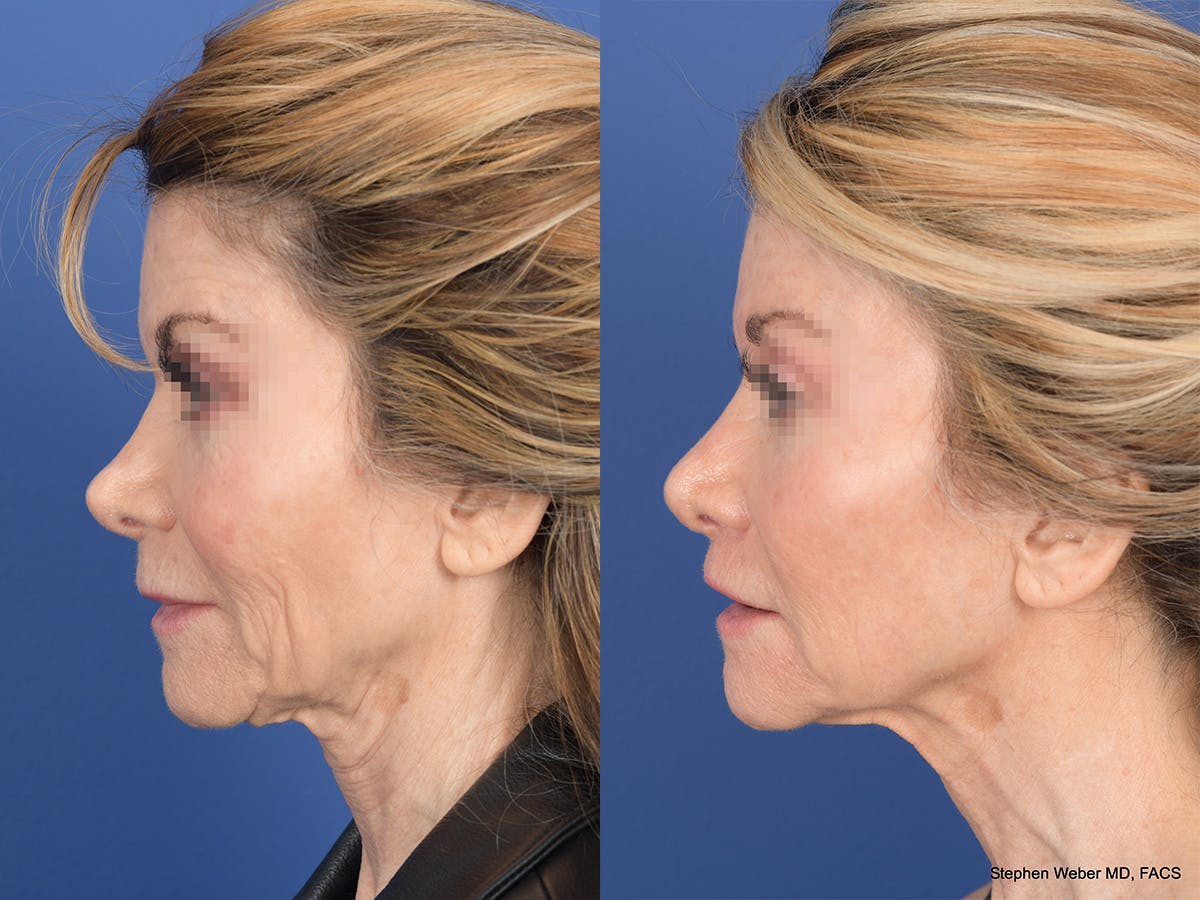 Revision Rhinoplasty Before & After Gallery - Patient 145048 - Image 2