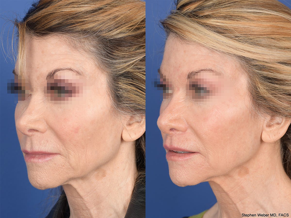 Revision Rhinoplasty Before & After Gallery - Patient 145048 - Image 3