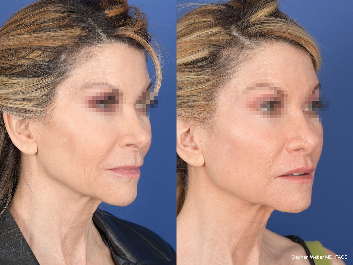 Revision Rhinoplasty Before & After Gallery - Patient 145048 - Image 4