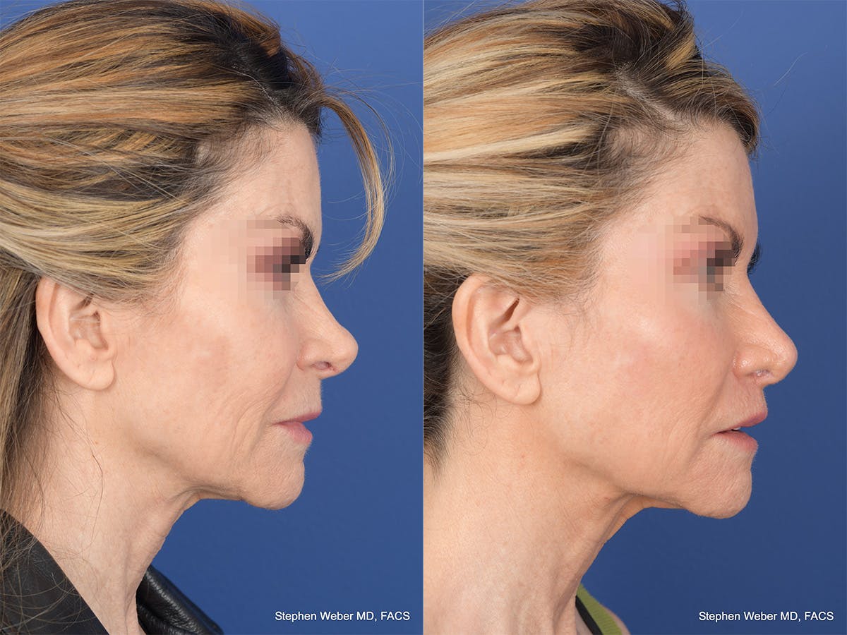 Revision Rhinoplasty Before & After Gallery - Patient 145048 - Image 5