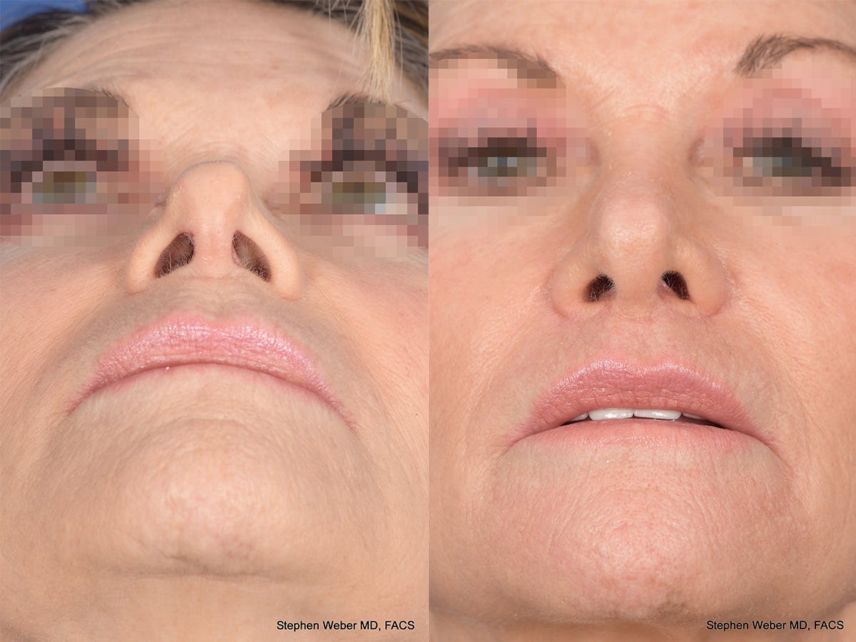 Revision Rhinoplasty Before & After Gallery - Patient 145048 - Image 6